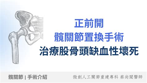 骨枯手術費用|【髖關節手術】即睇原理、副作用及詳細步驟+收費參。